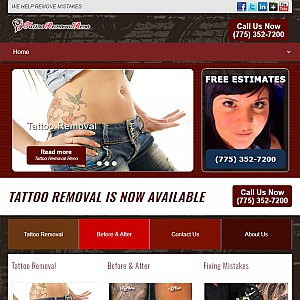 Tattoo Removal